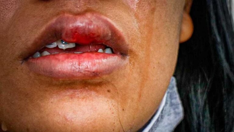 Após acabar cerveja marido bate em esposa e deixa ela sem os dentes da frente