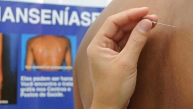 Janeiro Roxo chega para combater o preconceito e conscientizar sobre a Hanseníase