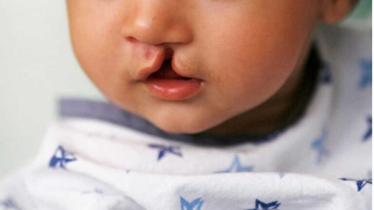 MS Saúde – Mais Saúde, Menos Fila’ realiza primeira cirurgia de correção de fissura lábio-palatal