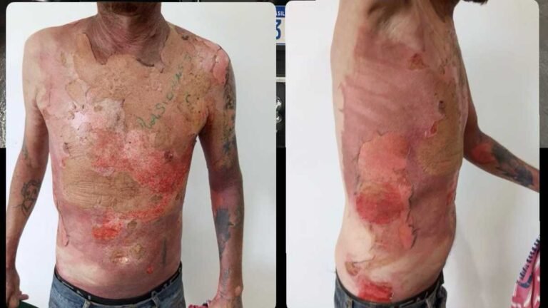 Polícia Civil prende mulher que atacou vizinho com água fervente enquanto dormia 