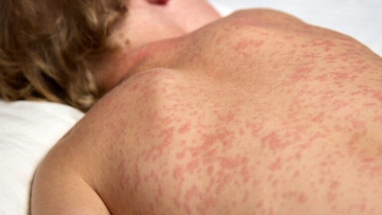 Busca ativa por casos de sarampo é intensificada em MS com apoio do Ministério da Saúde