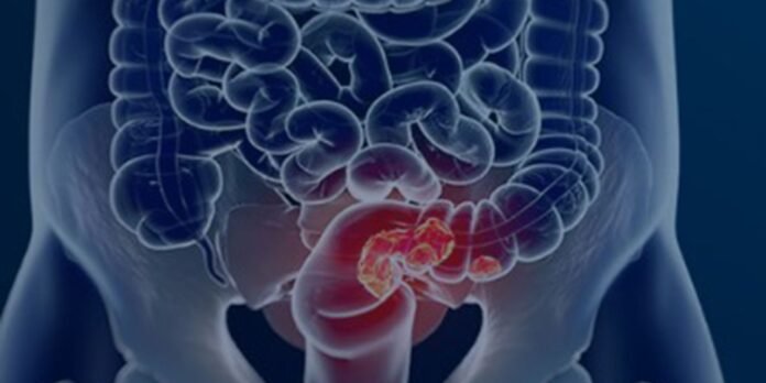 Medical diagram highlighting a colorectal cancer tumor in the lower colon/sigmoid area with surrounding intestines visible