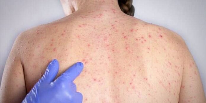 Back of a person with many small red rash patches; a gloved hand points to the skin.