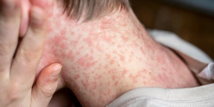 Close-up of a person's neck showing a red blotchy rash with a hand touching the skin.