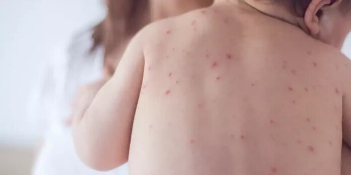Back view of a baby with many small red rashes on the back and shoulder area.
